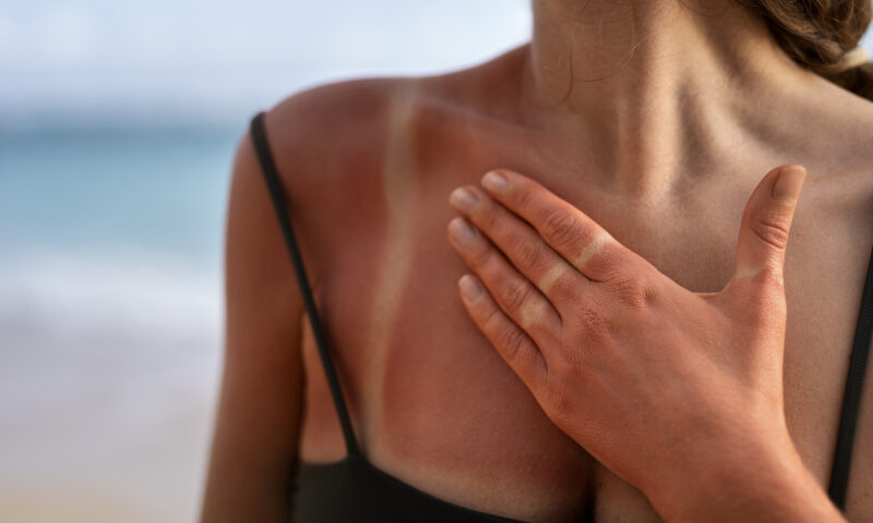 How To Turn a Sunburn Into a Tan Overnight