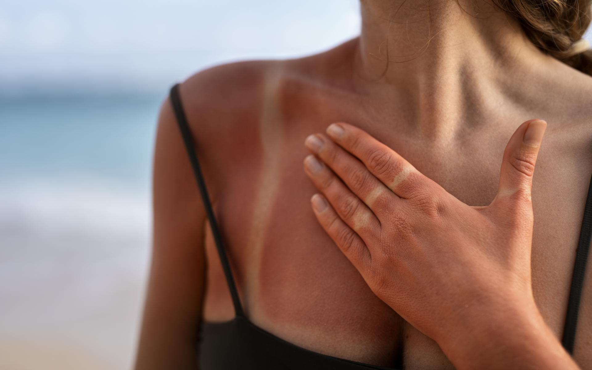How To Turn A Sunburn Into A Tan Overnight